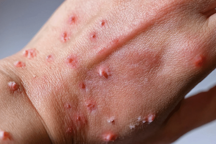 DOH confirms first case of mpox in the province.